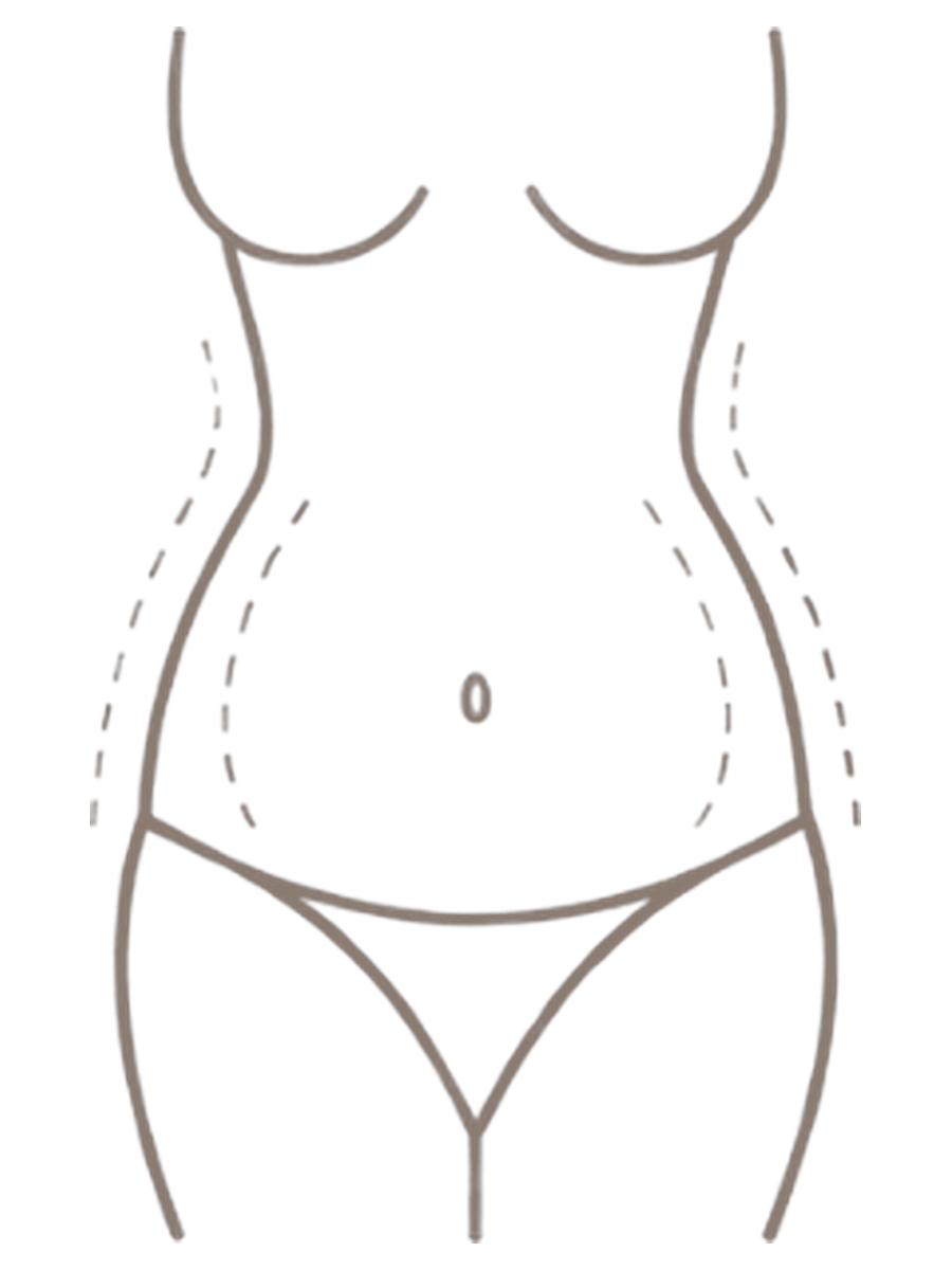 Lipoescultura — antes