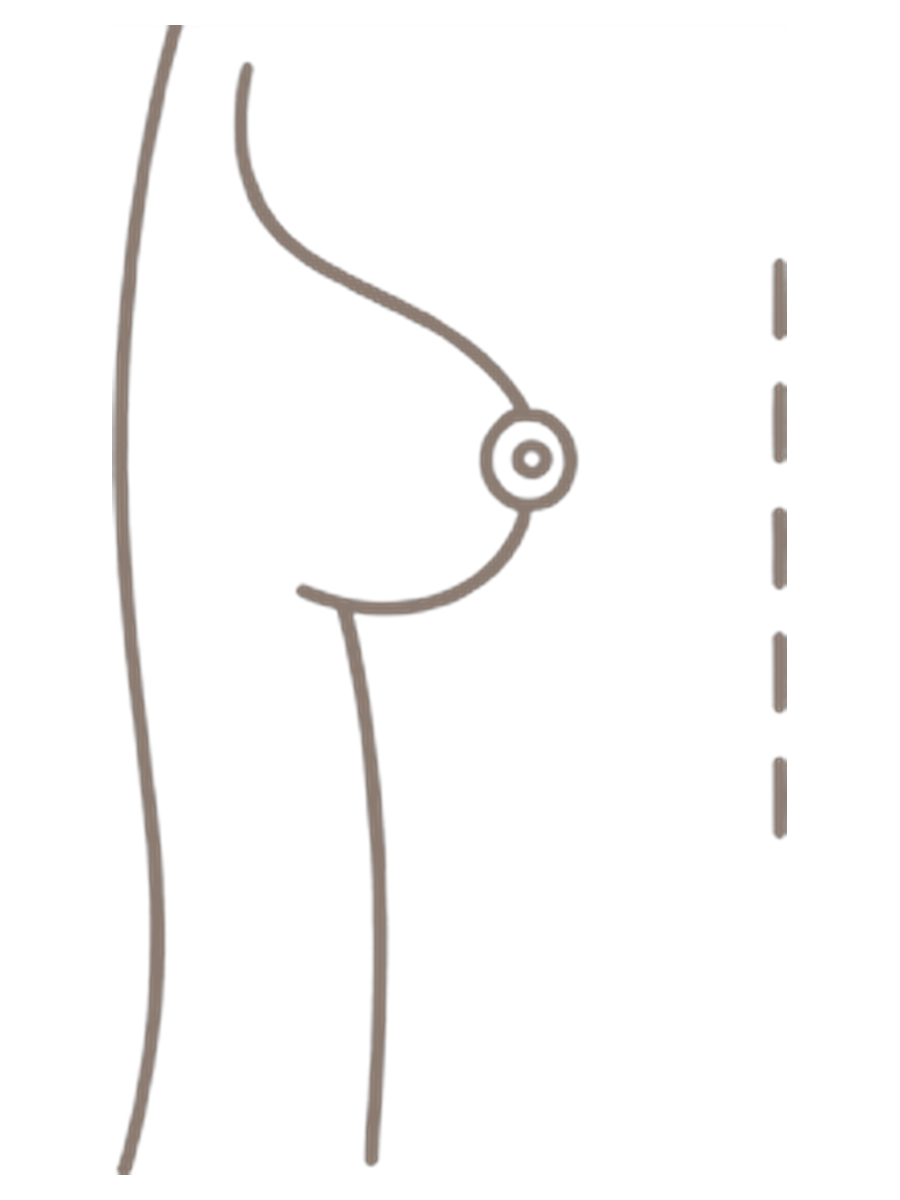 Mamoplastia de aumento — antes