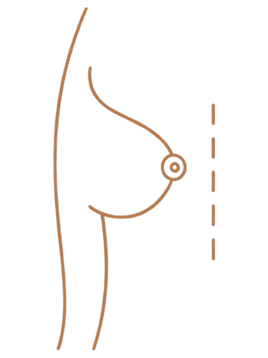 Mamoplastia de aumento — después